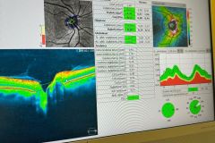Zdjecie-badania-Gdxhrt-octdna-oczu
